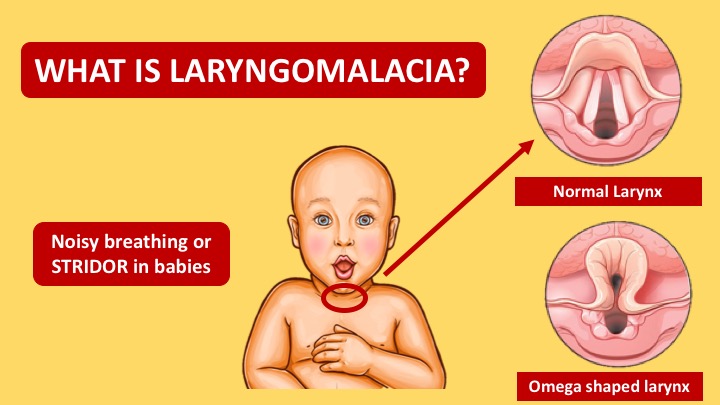 Lryngomalacia