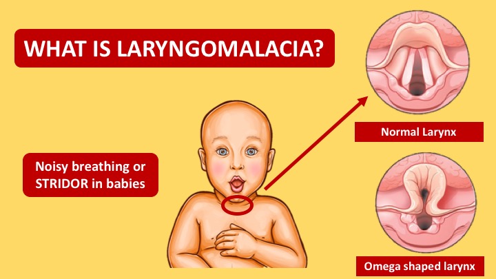 Laryngomalacia: When do we really need to Investigate?