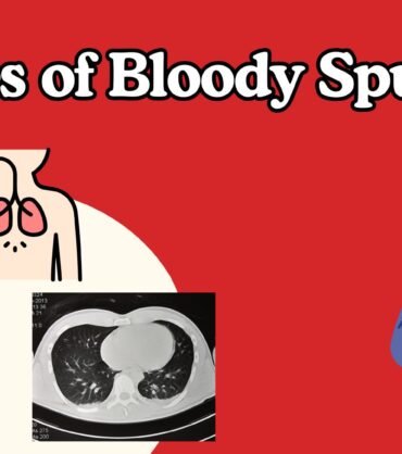 Hemoptysis: Blood in Sputum in Children